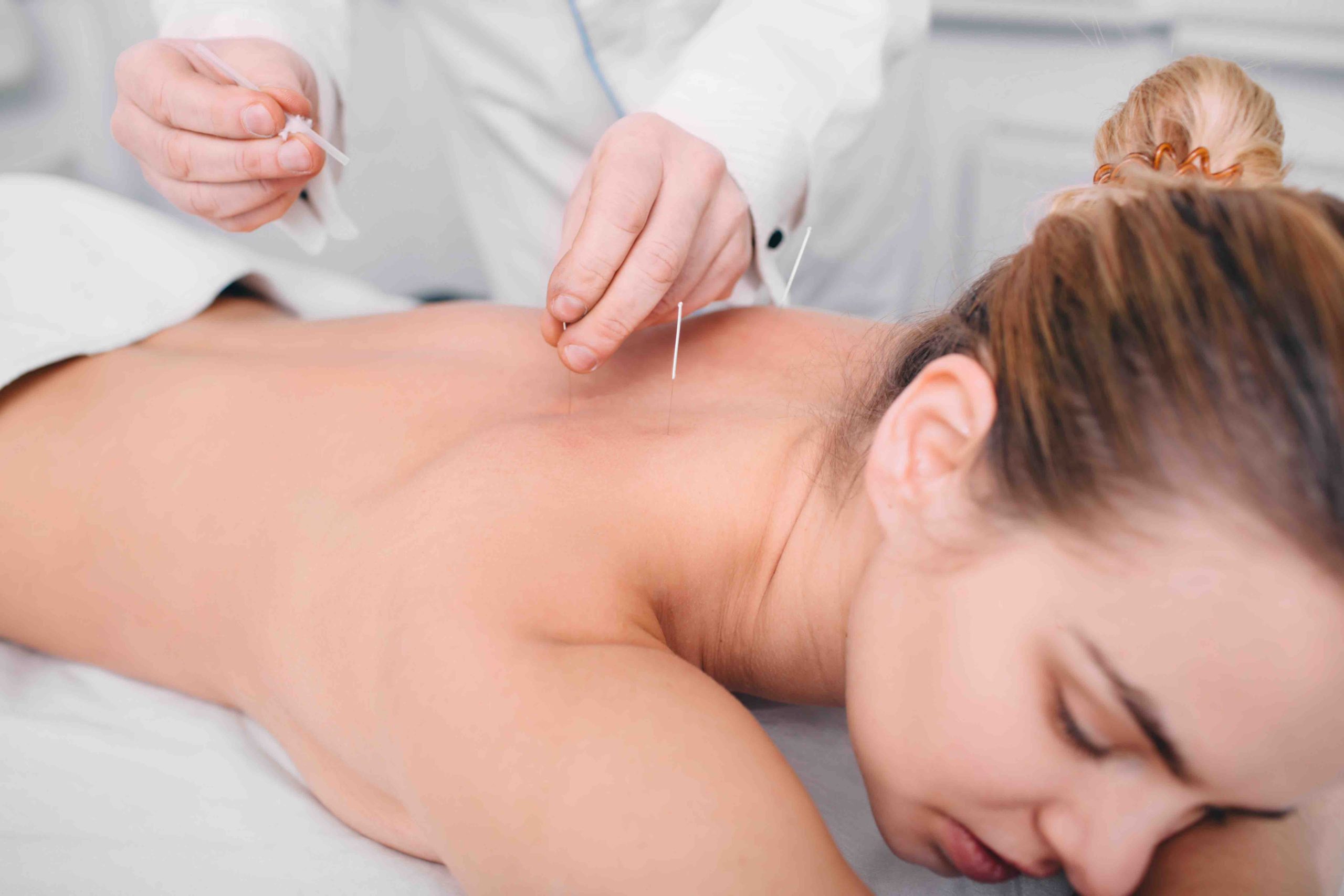 Acupuncture