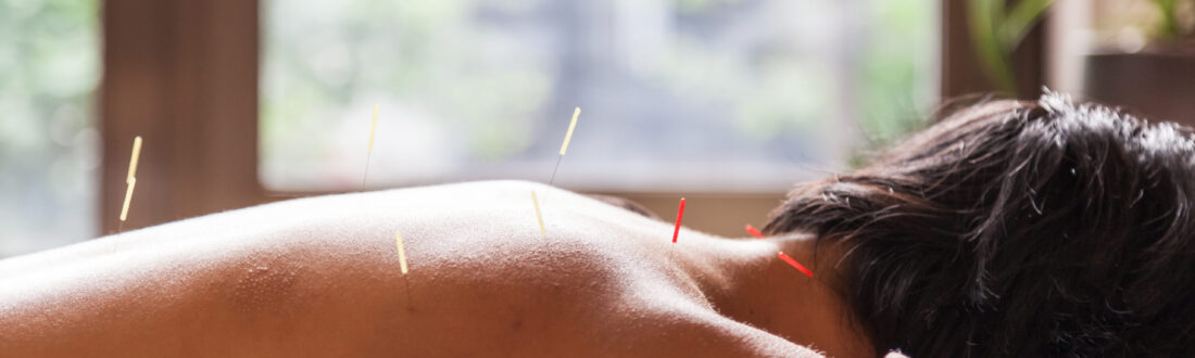 Acupuncture Treatment in Carlow. 